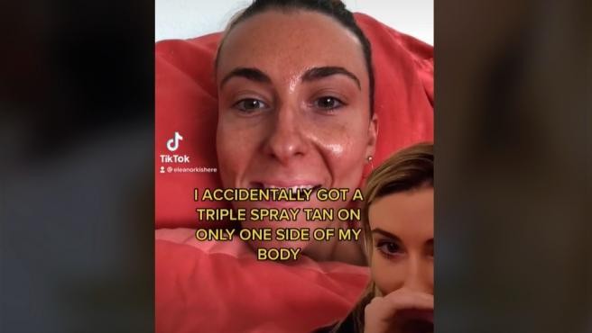 Así quedó una mujer tras una sobredosis de spray de bronceado | Internacionales