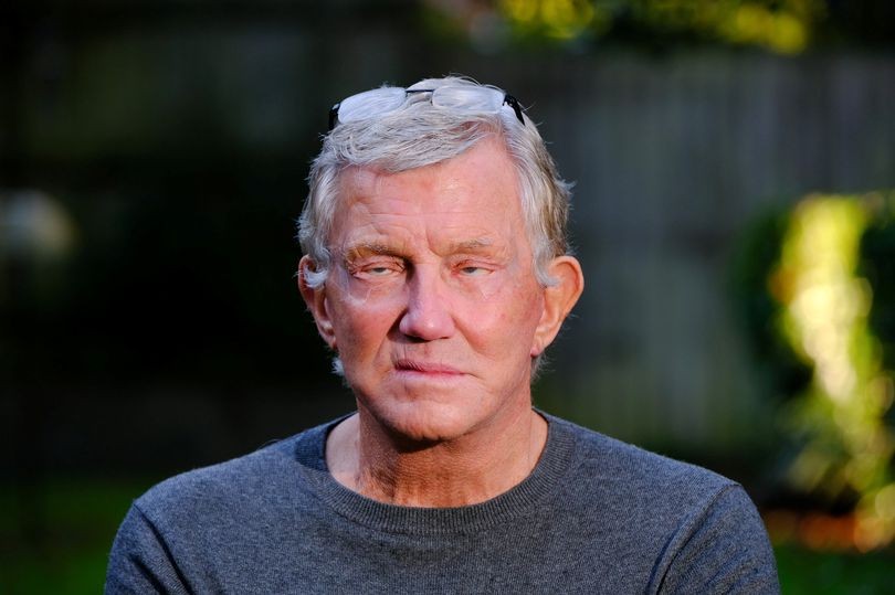 Un hombre lleva tres años sin poder cerrar los ojos tras cirugía plástica fallida | Curiosidades