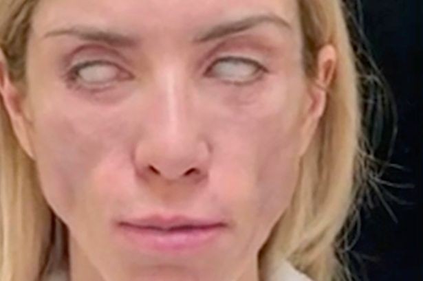 La rusa reina de belleza que no puede cerrar los ojos ni sonreír por culpa de una cirugía estética | Internacionales