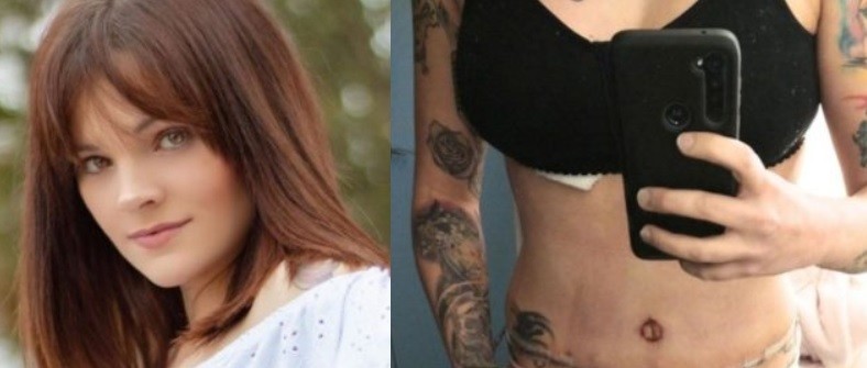 Fue a someterse a una reducción de mamas pero le colocaron implantes y le realizaron una liposucción | Internacionales