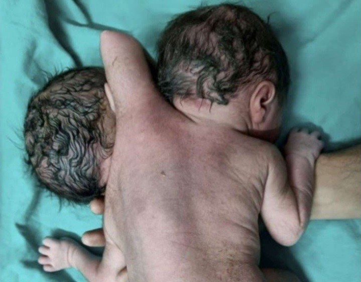 Les dijeron que esperaban mellizos: nació un bebé con dos cabezas | Internacionales