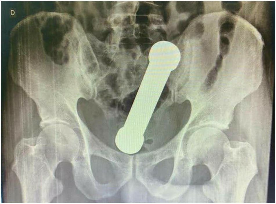 Un hombre va al hospital por dolor de estómago: le extrajeron mancuerna de dos kilos del cuerpo | Internacionales