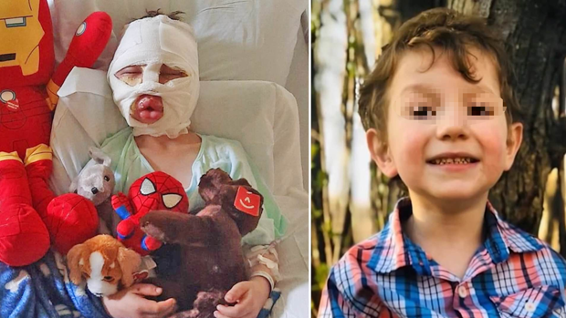 Bullying: un nene de 6 años sufrió quemaduras tras el ataque de otros chicos con una pelota de tenis en llamas | Internacionales
