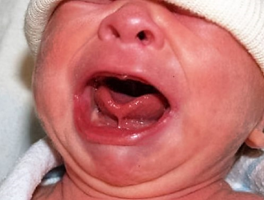 La moda de cortar el frenillo de la lengua de los bebés para favorecer la lactancia | Internacionales