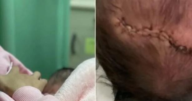 Una bebé recién nacida cayó de cabeza minutos después del parto y tuvieron que darle 11 puntos de sutura | Internacionales
