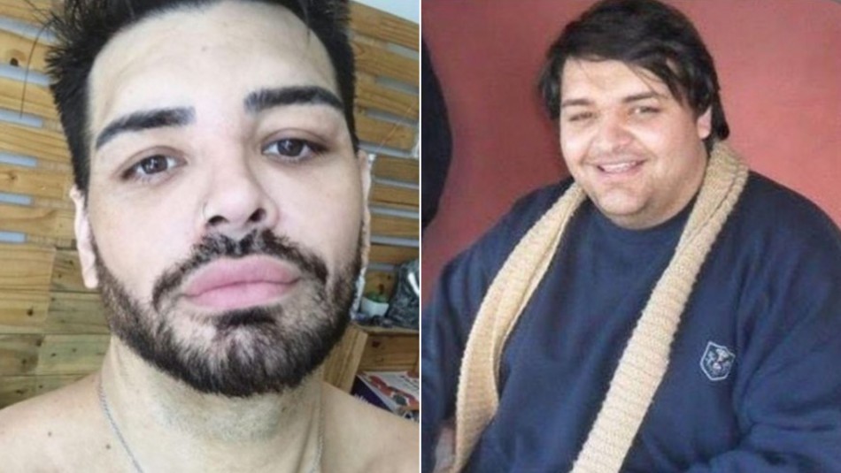 El exparticipante de Cuestión de peso que se hizo más de 30 cirugías en la cara: “Quedé más lindo que Ricky Martin” | Curiosidades