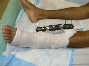 Ingresó a robar, se fracturó una pierna y fue detenido | Actualidad