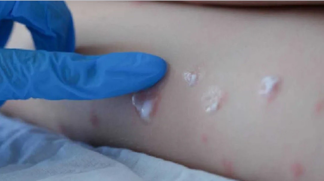 Confirman el primer caso de viruela del mono en Mendoza | Salud