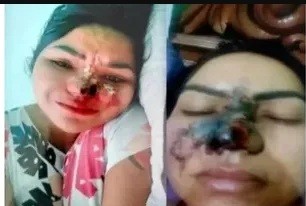 Se operó la nariz con un dentista y quedó desfigurada | Curiosidades