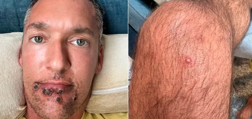 Un actor porno mostró las heridas tras contagiarse de viruela del mono | Internacionales