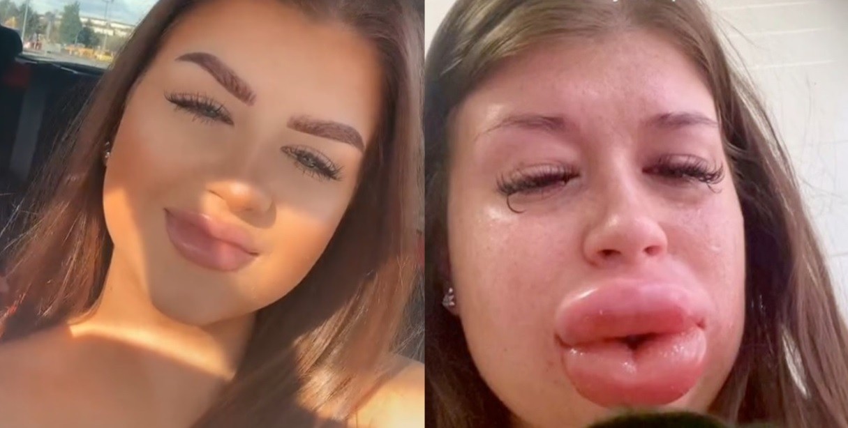 Rompió en llanto al comprobar que su cara se deformaba por un tratamiento estético fallido | Política y economía