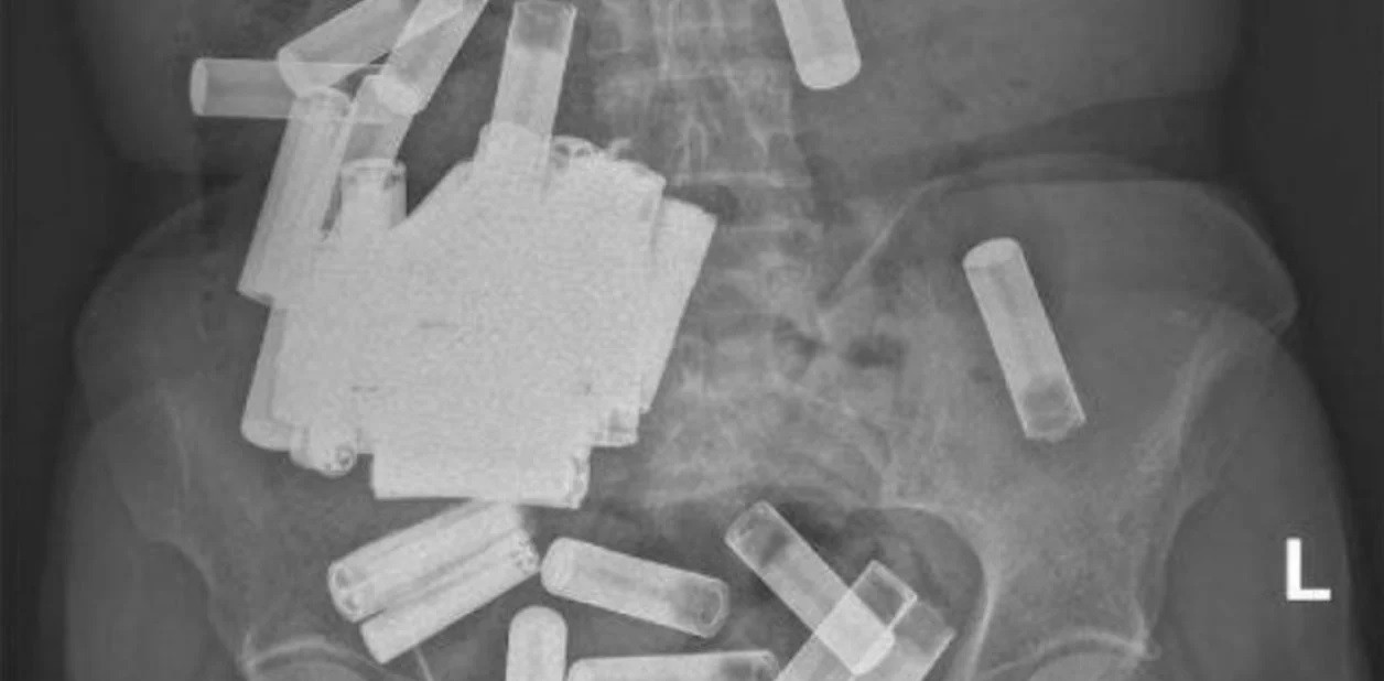 Tenía dolor de panza y le extrajeron 55 pilas del cuerpo | Internacionales