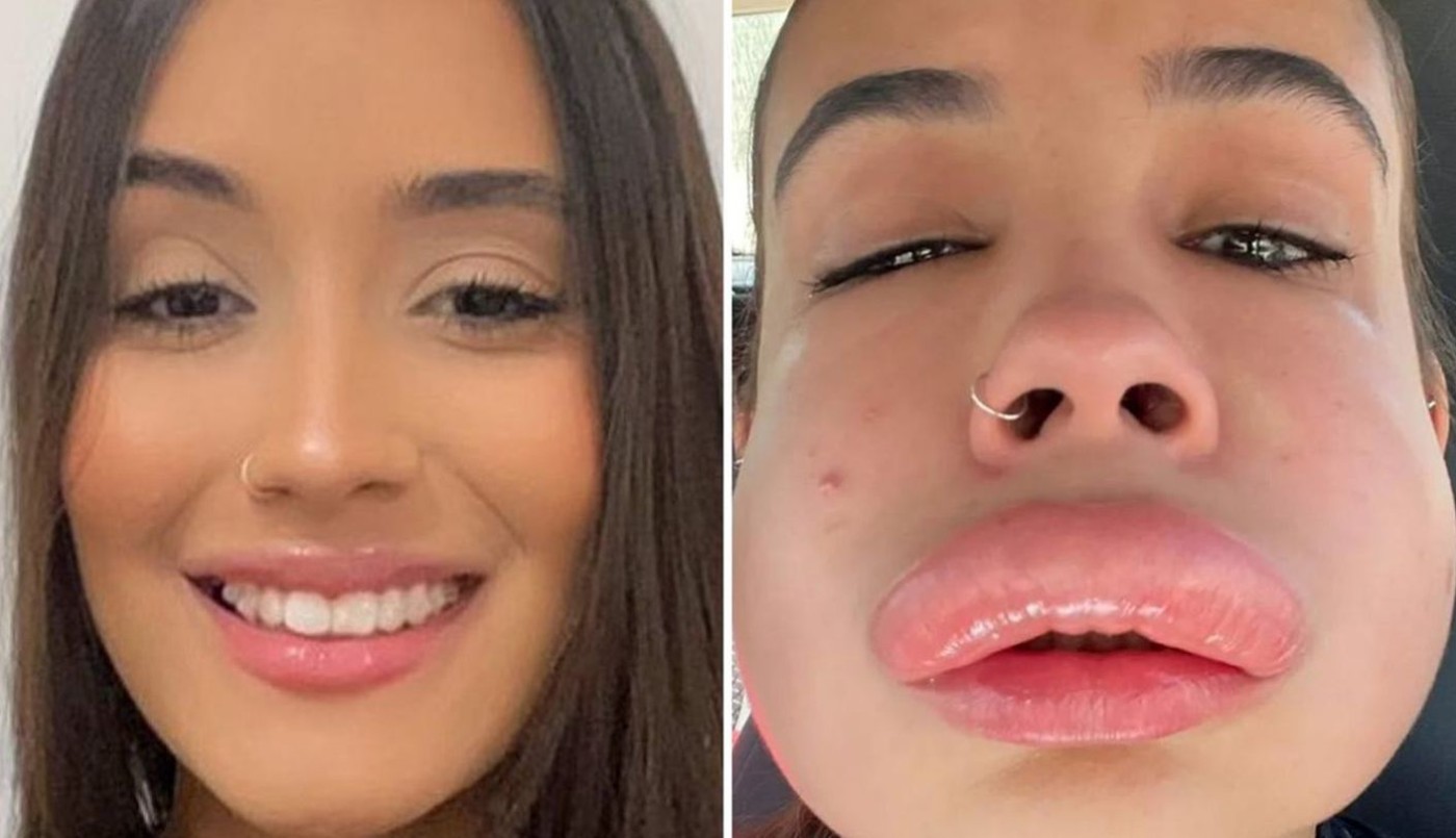"¿Qué hice?": el susto de una joven de 20 años tras el fallido intento de rellenarse los labios | Internacionales