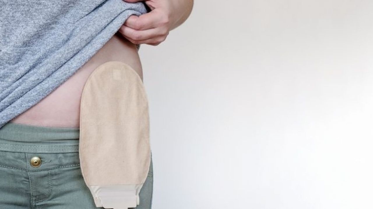 Once provincias adhirieron a la ley que da cobertura a personas ostomizadas | Actualidad