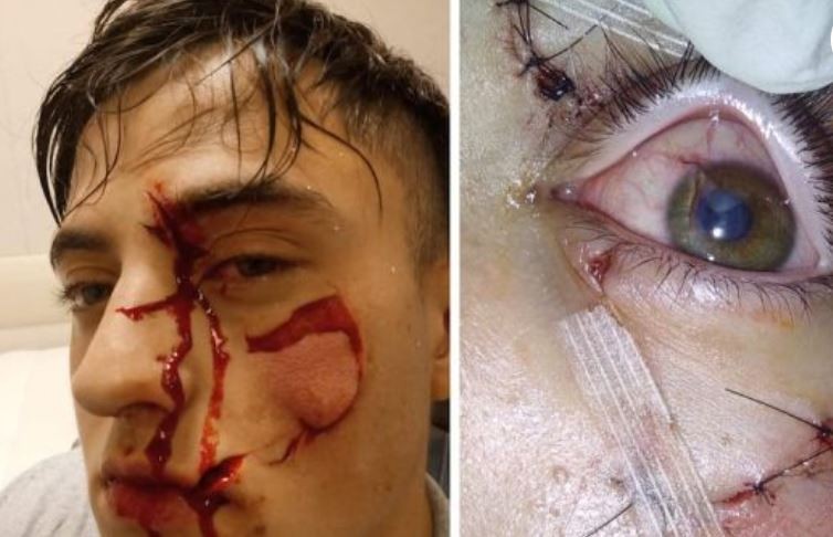 Vio a un amigo hablando con su ex novia y lo desfiguró: "¿Qué voy a hacer? Me cegué" | Actualidad