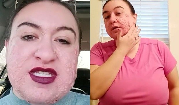 "Me dicen Freddy Krueger": sufre una rara enfermedad de la piel y el bullying | Internacionales