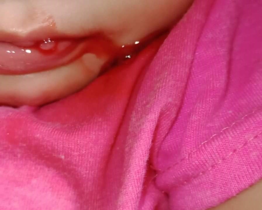 La beba que "sangra por la boca" ya tiene diagnóstico | Internacionales