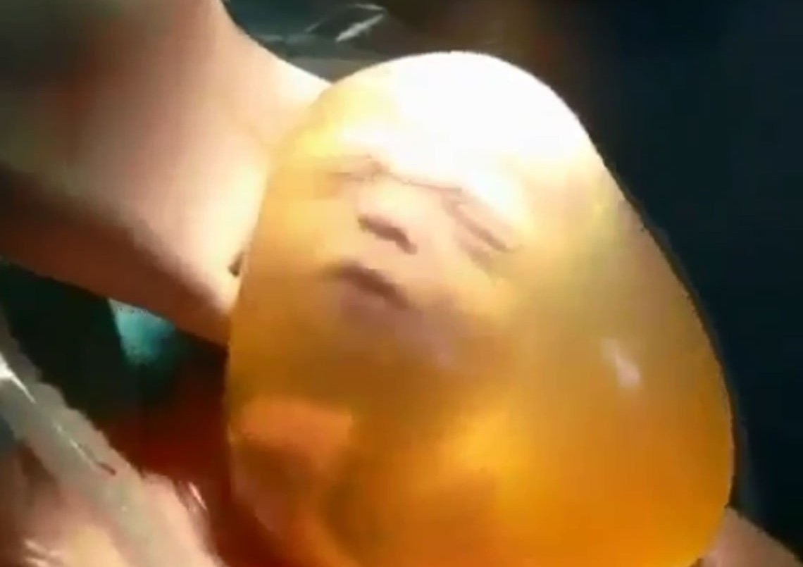 Parto velado en Rosario: ocurre uno cada 80 mil nacimientos | Actualidad