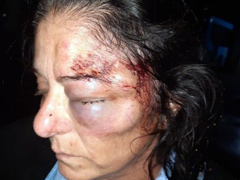 Desfiguraron a colectivera con brutal golpiza durante un robo | Actualidad