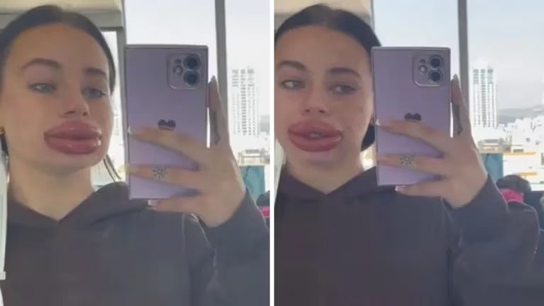 Video: se puso ácido hialurónico en los labios, el resultado no fue el esperado y se hizo viral | Internacionales