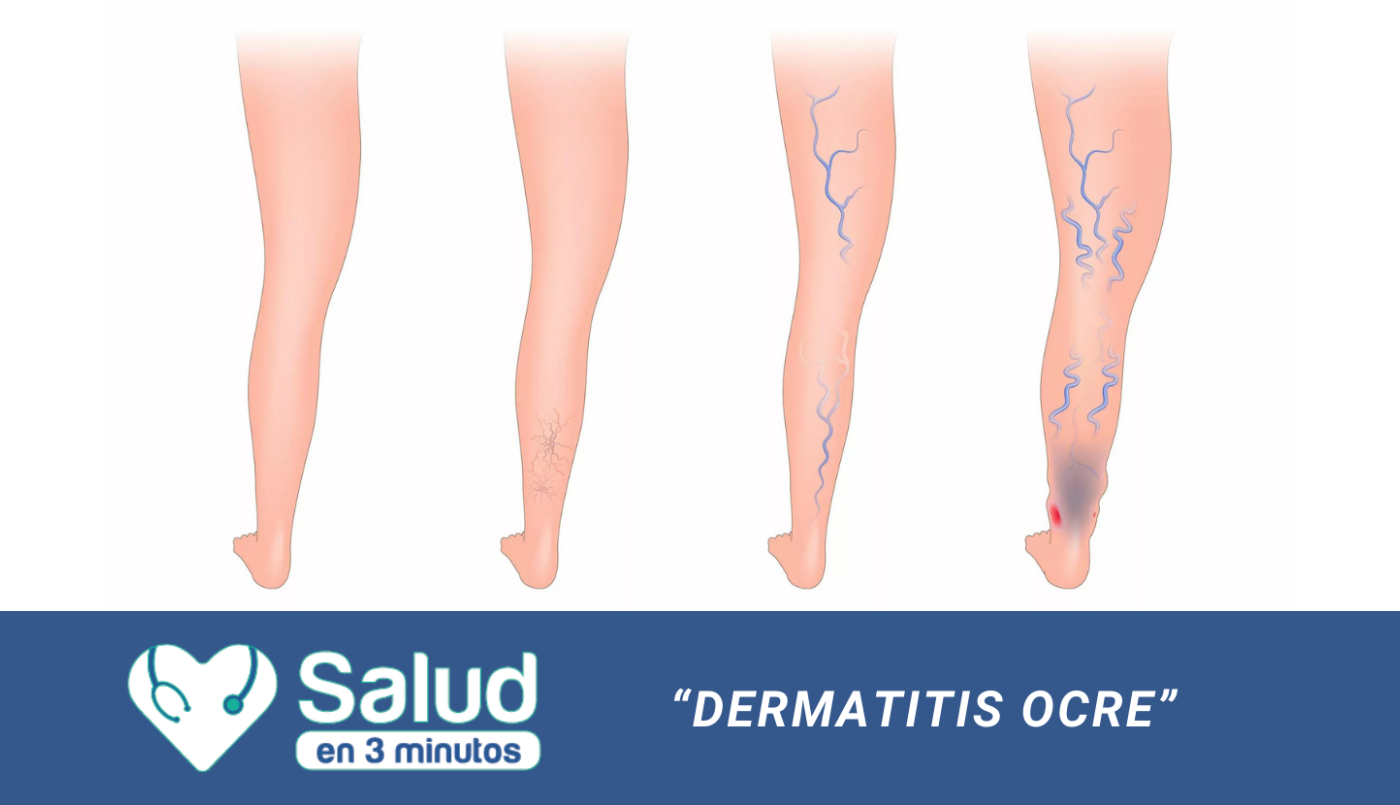 Dermatitis Ocre: una mancha marrón en la piel a la cual prestar atención si tenes varices | Salud