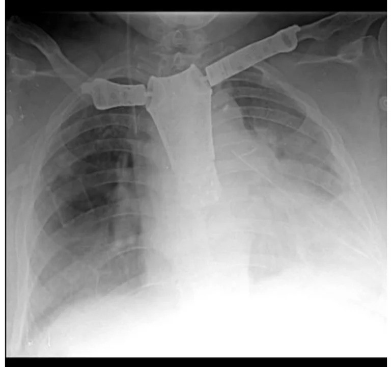 Hospital de Córdoba Realiza Histórica Cirugía con Prótesis de Impresión 3D | Córdoba