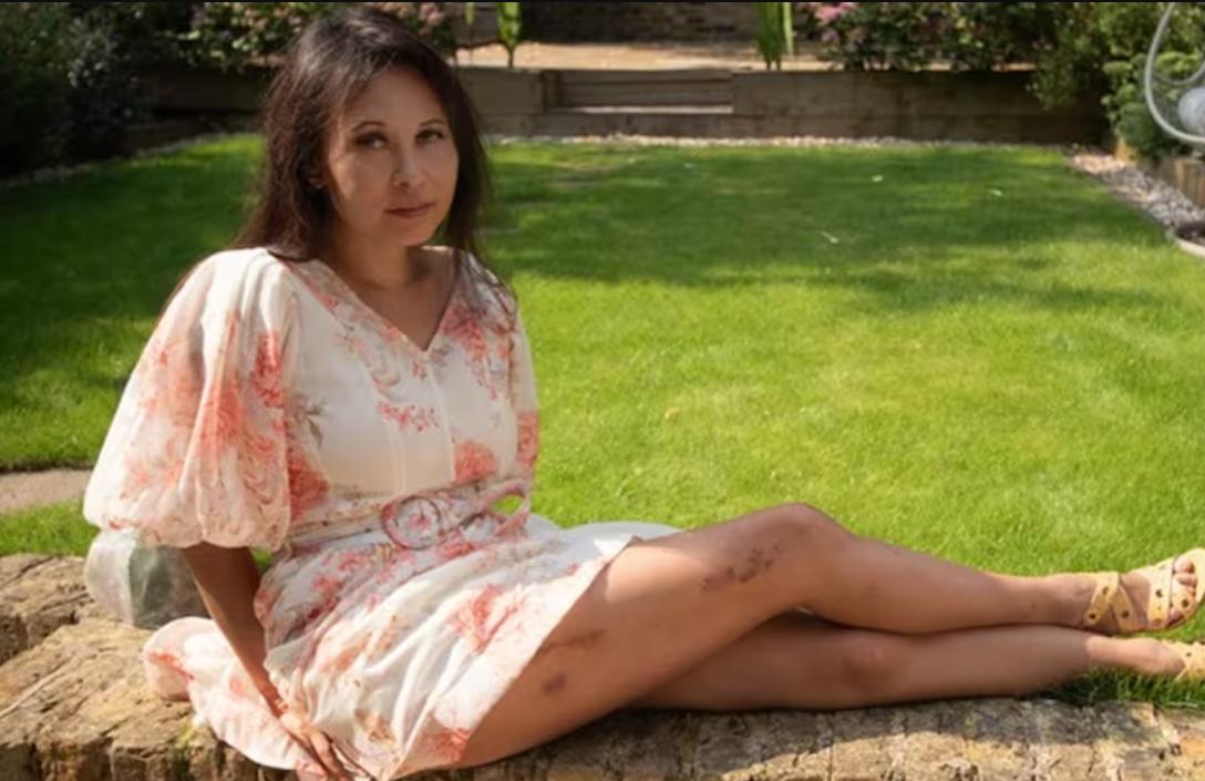 La pesadilla de una mujer que se sometió a una procedimiento para alargarse las piernas | Actualidad