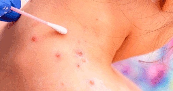 El Ministerio de Salud provincial presentó el protocolo de acción por la viruela del mono | Córdoba