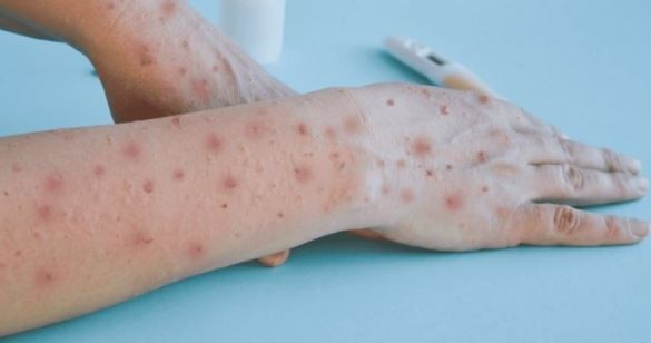 Identificaron 22 casos de la viruela del mono en la Argentina | Actualidad