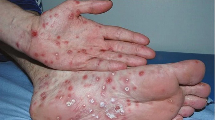 Preocupa un fuerte brote de sífilis en Argentina | Actualidad