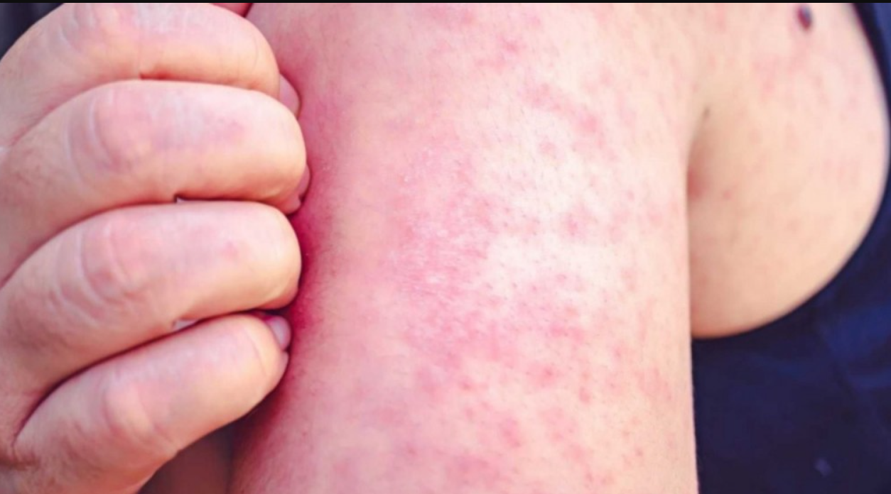 "El brote de sarampión es porque no nos vacunamos", aseguró el infectólogo Hugo Pizzi | Actualidad