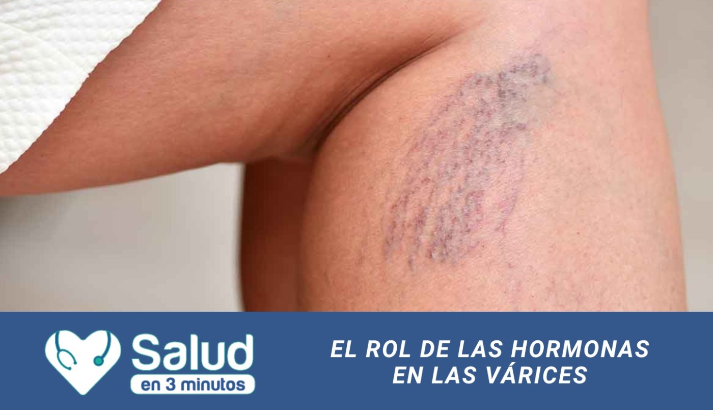 ¿Cómo es el impacto hormonal en la aparición de várices y arañitas? | Salud