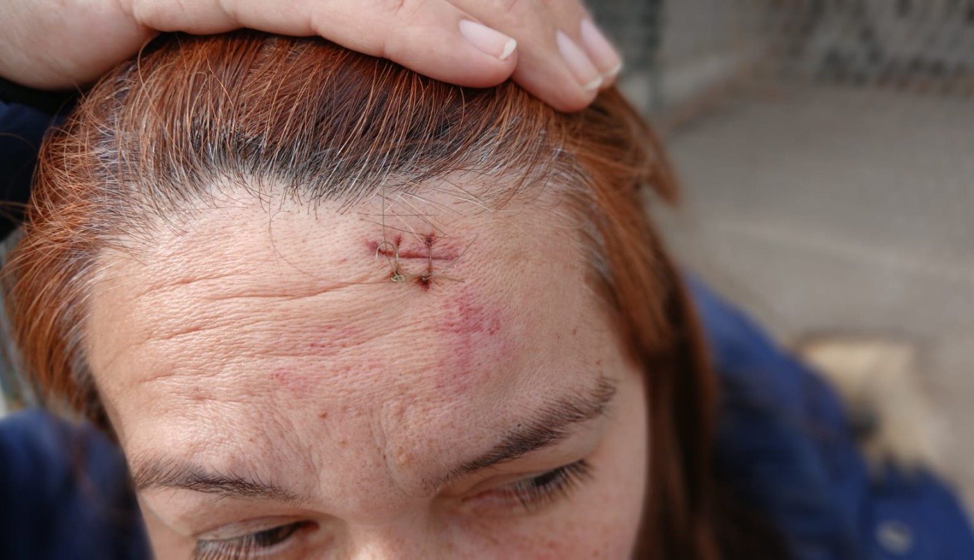 La golpearon hasta abrirle la cabeza para robarle el celular en barrio Carrara de Horizonte Norte | Córdoba