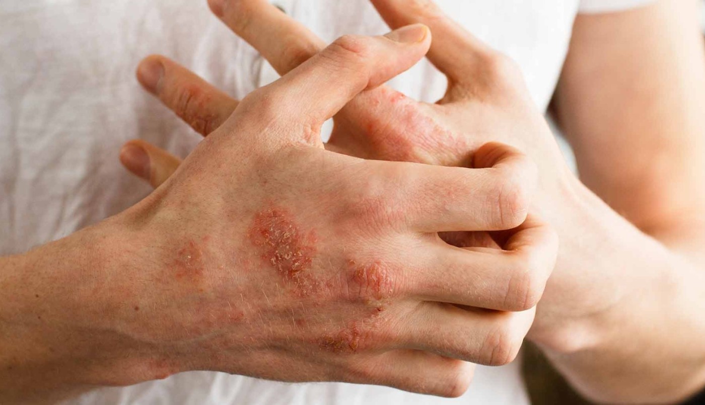 Córdoba brinda consultas gratuitas para detectar la psoriasis: cómo sacar turno | Córdoba