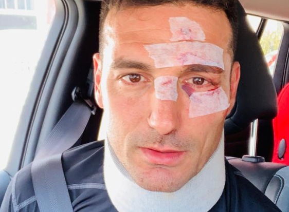 Así quedó Lionel Scaloni tras el accidente | Deportes