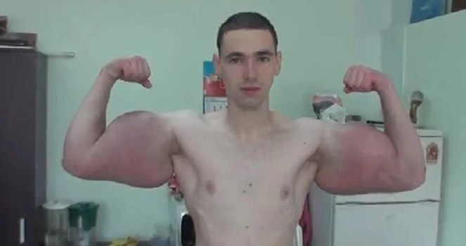 El drama del "Hulk" ruso: no soporta el dolor y quiere salvar sus brazos de la amputación | Actualidad