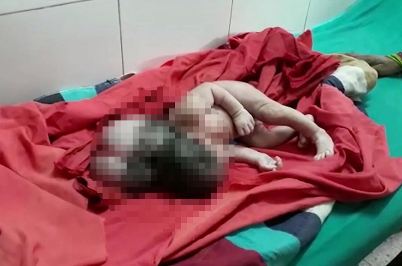 Conmoción por el nacimiento de una bebé de tres cabezas | Actualidad