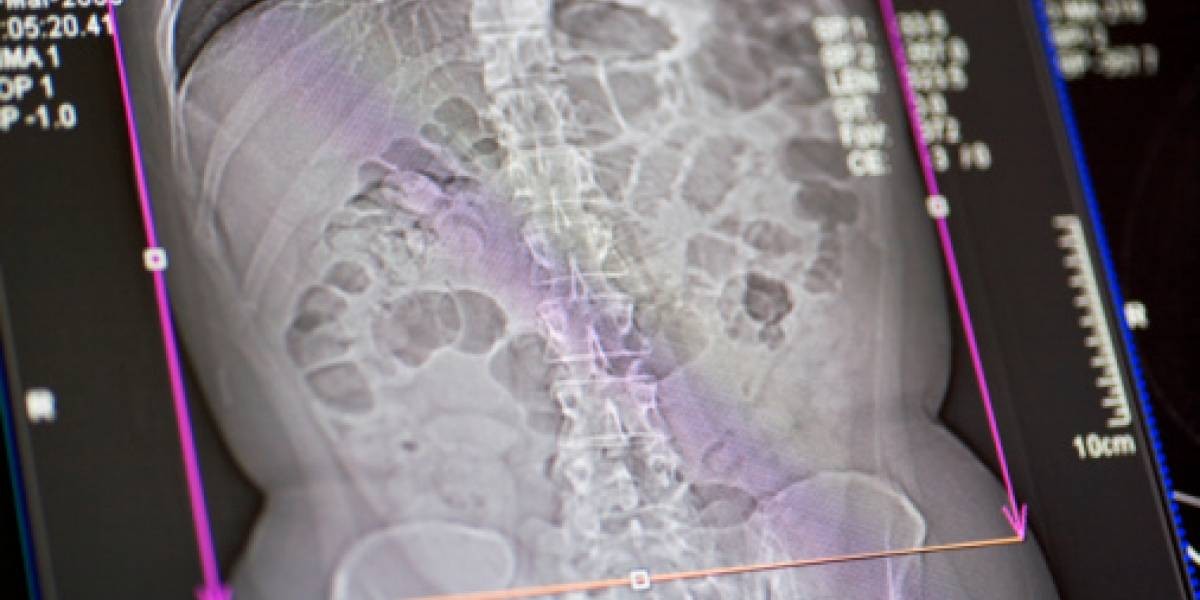 Sufría dolores en el estómago: lo operaron y le extrajeron a su gemelo con pelos y dientes | Curiosidades