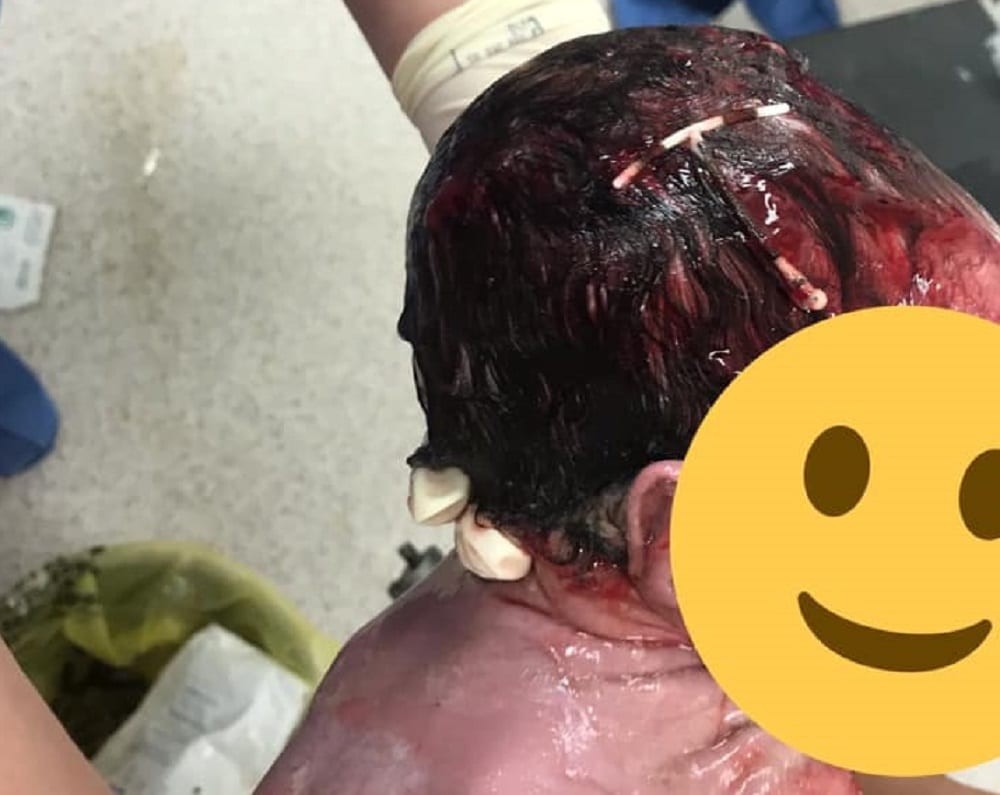 La foto viral del bebé que nació con un DIU pegado en la cabeza | Curiosidades