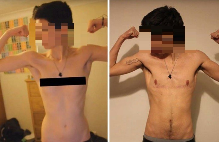 Un juez autorizó a quitarse las mamas a joven trans de 16 años en San Juan | Actualidad