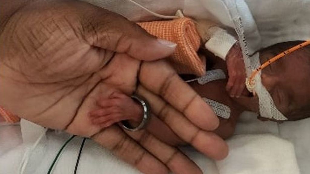 La milagrosa recuperación de la bebé prematura que nació pesando 370 gramos | Internacionales