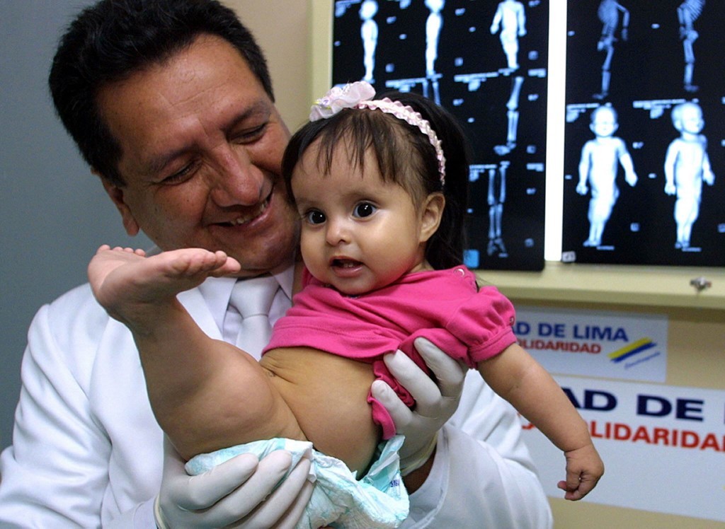 Murió la "nena sirena" de Perú | Internacionales