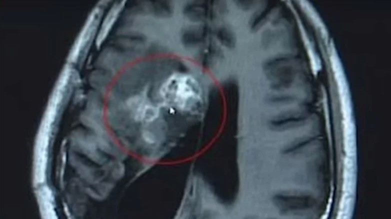 Le extirparon de la cabeza un parásito vivo que comió su cerebro durante 15 años | Curiosidades