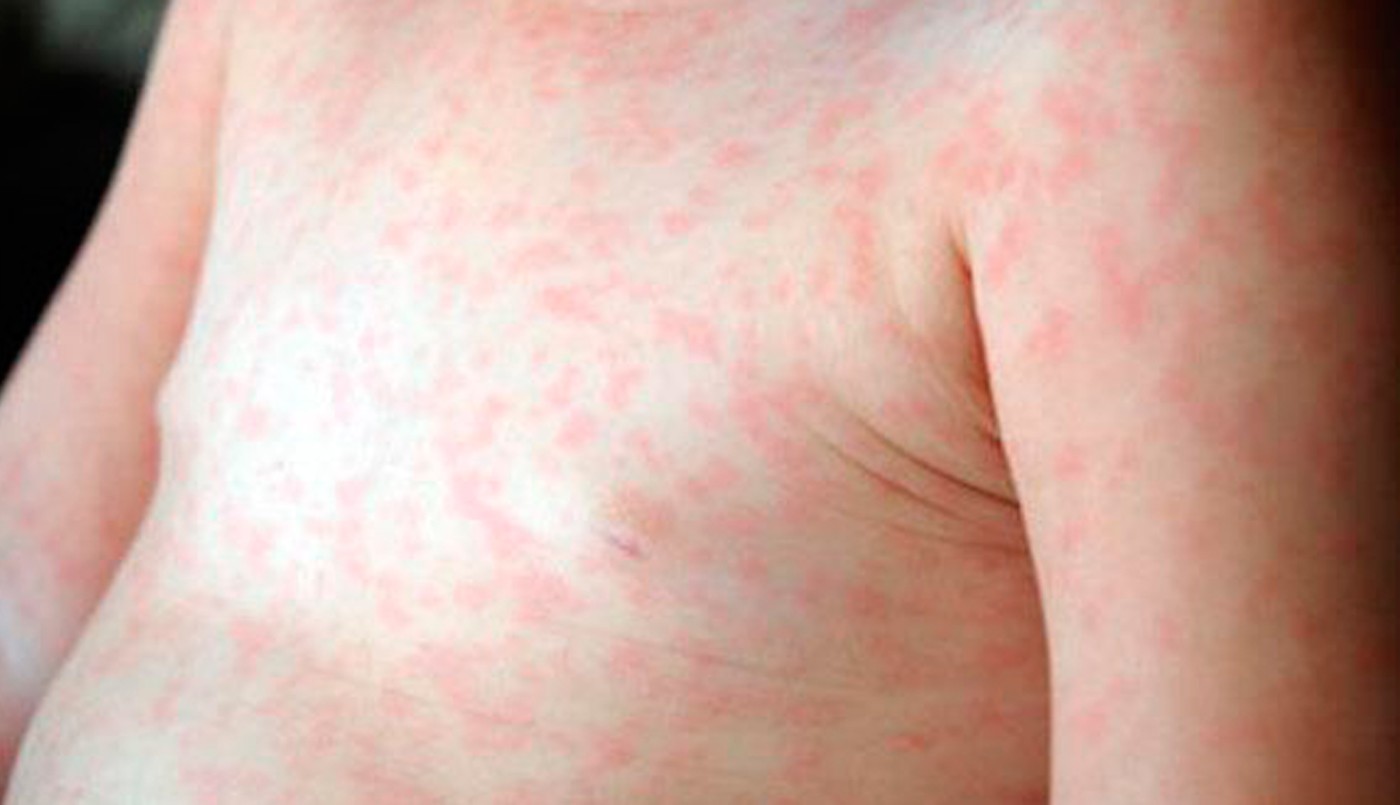 Buenos Aires: se confirmaron que ya son los 61 casos de sarampión | Actualidad