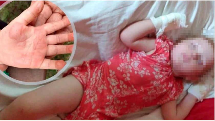 Impactantes imágenes de las quemaduras que recibió una nena en el puente de Carlos Paz | Córdoba