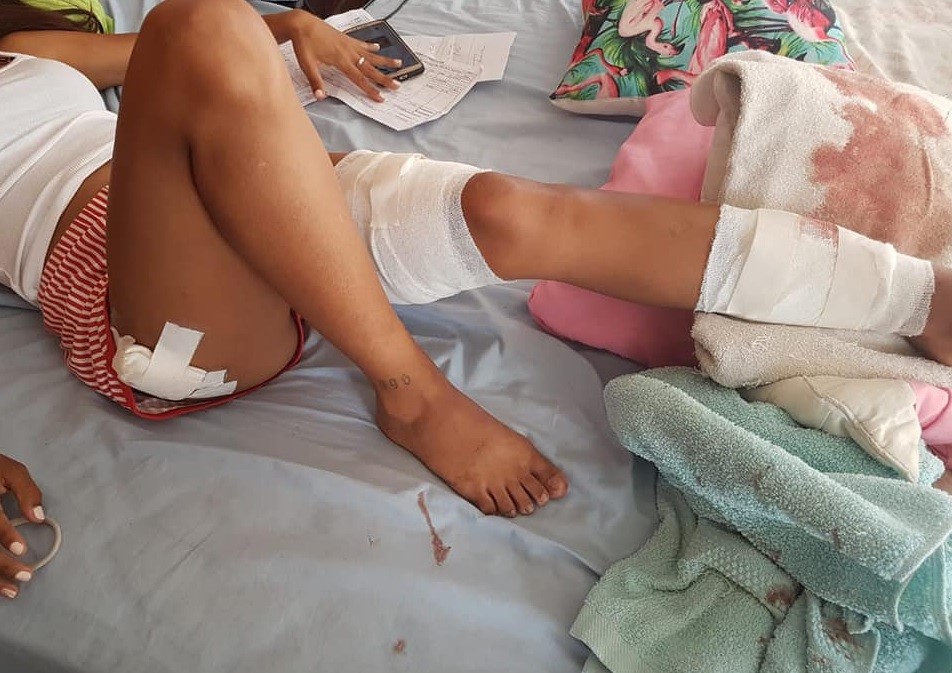 Otra vez: feroz ataque de dos perros pitbull a una joven en Mar del Plata | Actualidad