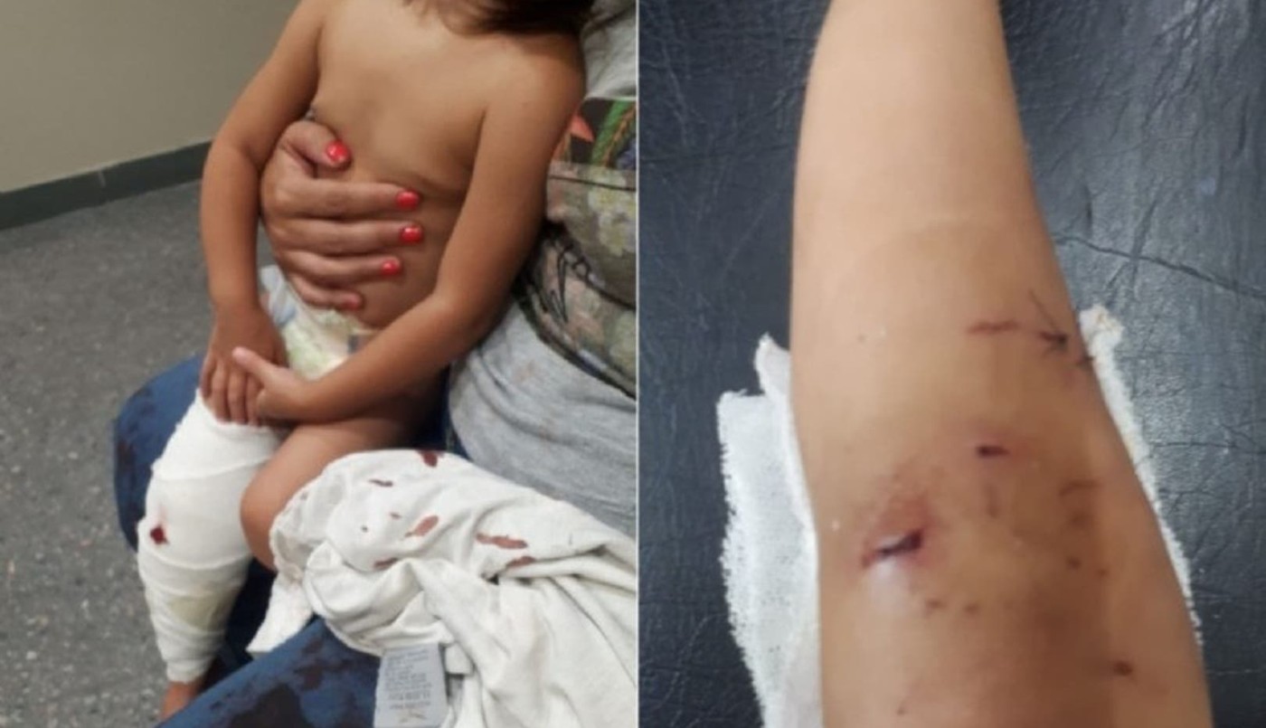 Un pitbull atacó a una beba, le dieron 40 puntos y no saben si caminará con normalidad | Actualidad