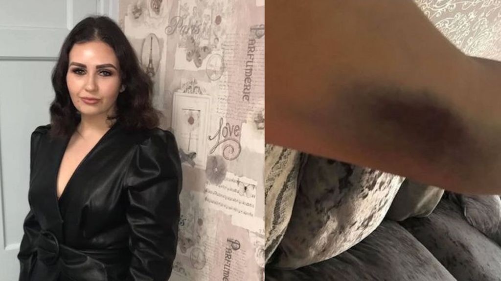 Le descubrieron unos moretones en el cuerpo y murió una semana después | Internacionales