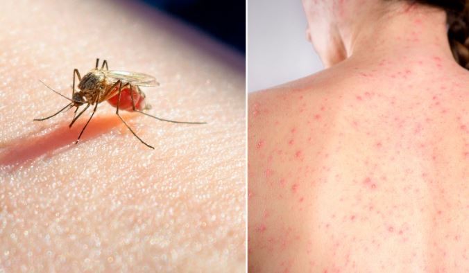 Confirman la muerte de una mujer por sarampión y la de un hombre por dengue | Actualidad