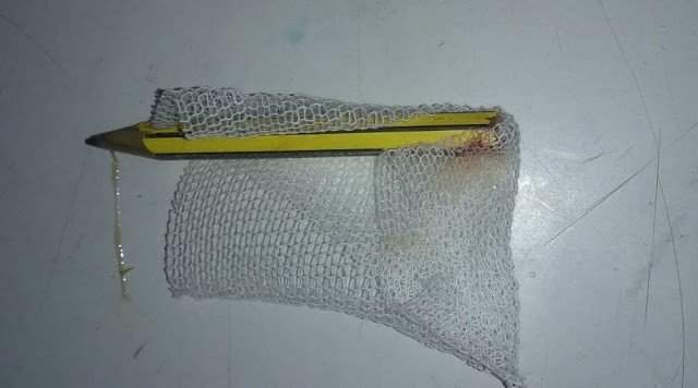 Una nena tuvo clavado un lápiz en el glúteo más de 3 meses | Curiosidades